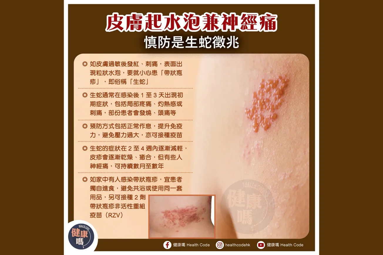 皮膚起水泡兼神經痛 慎防生蛇徵兆