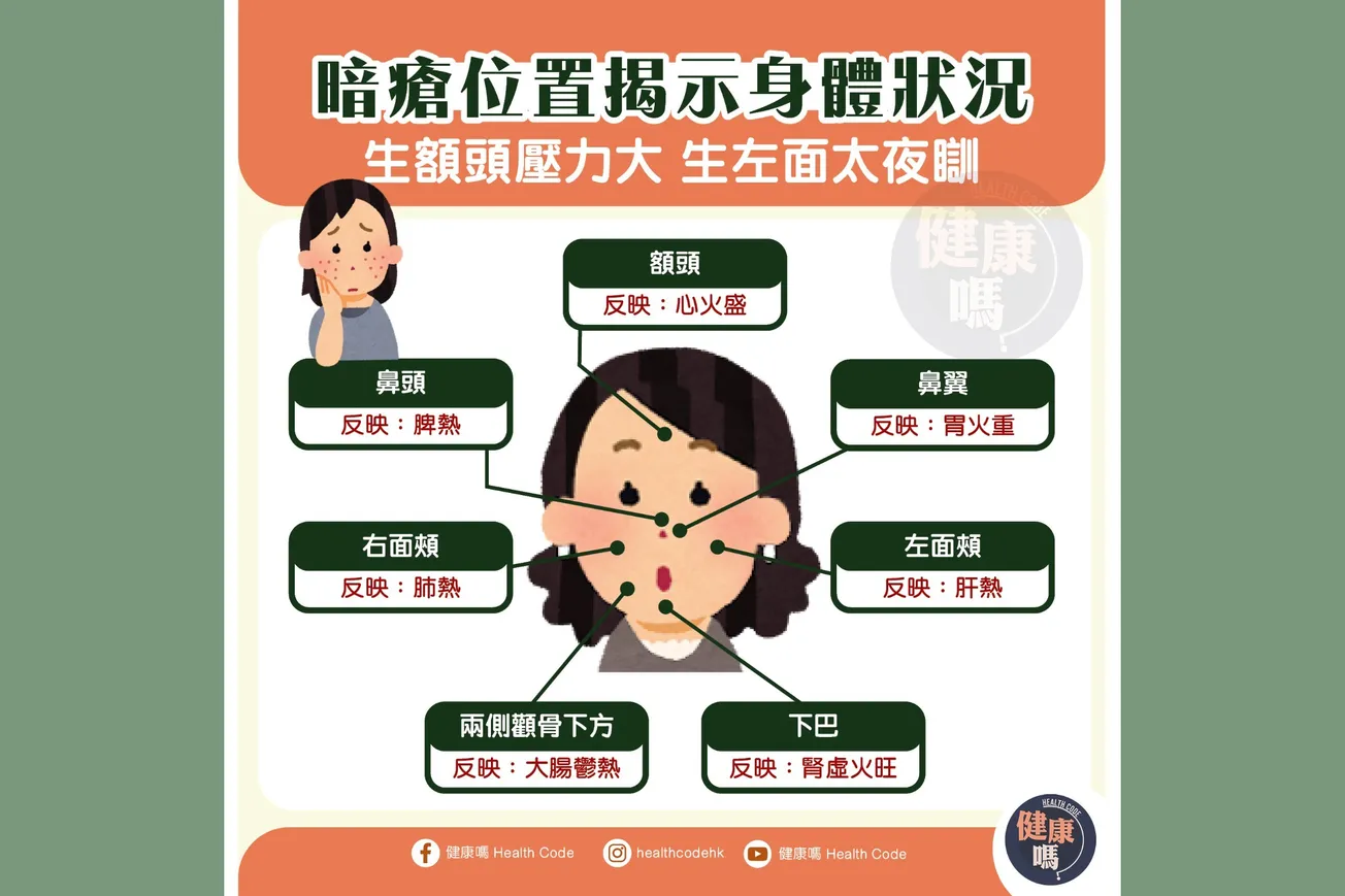 暗瘡位置揭示身體狀況 生額頭壓力大 生左面太夜瞓