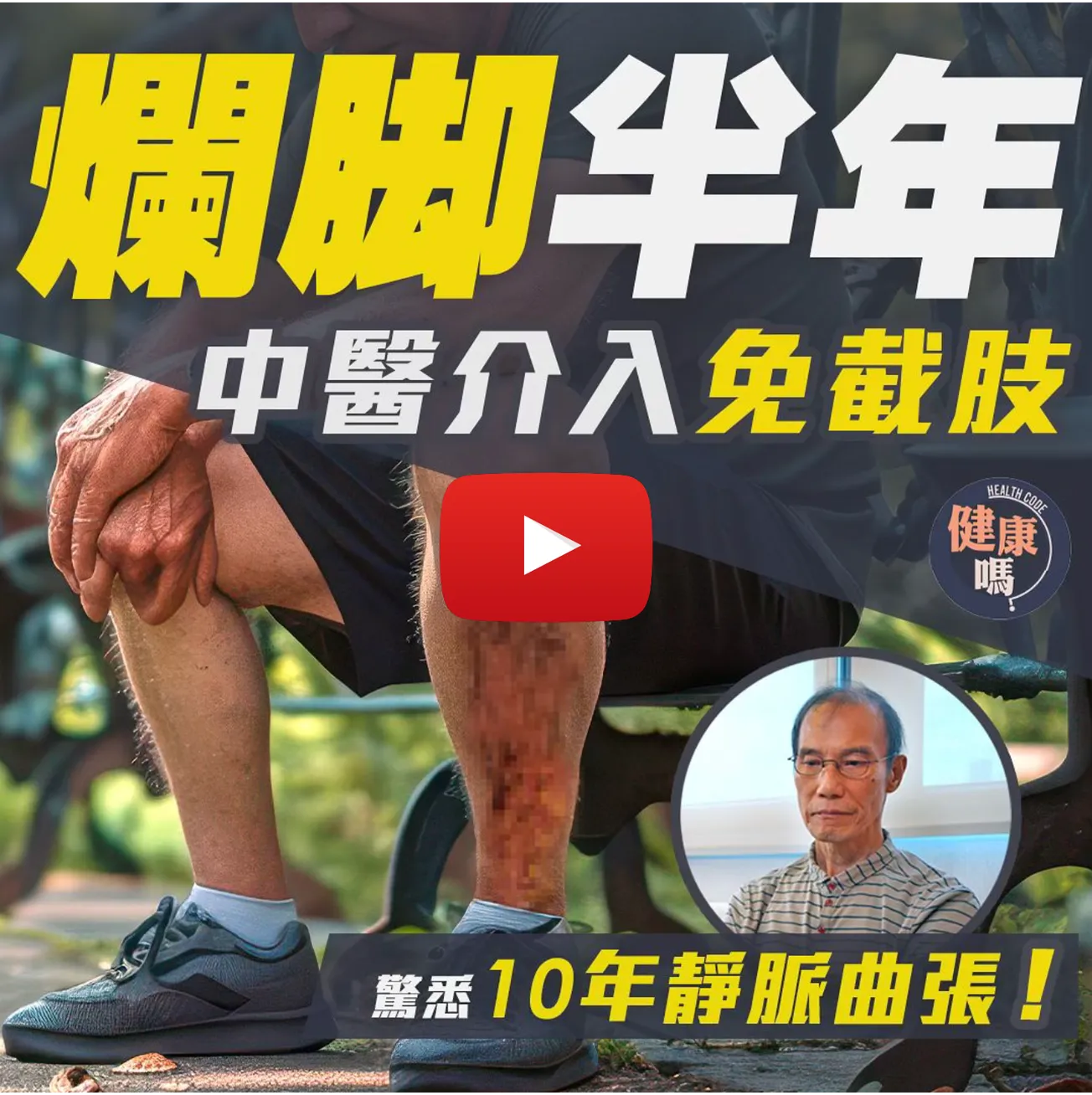 爛腳半年險截肢 10年靜脈曲張懵然不知 中醫介入方痊愈｜正確認識靜脈曲張6階段｜2動作預防舒緩