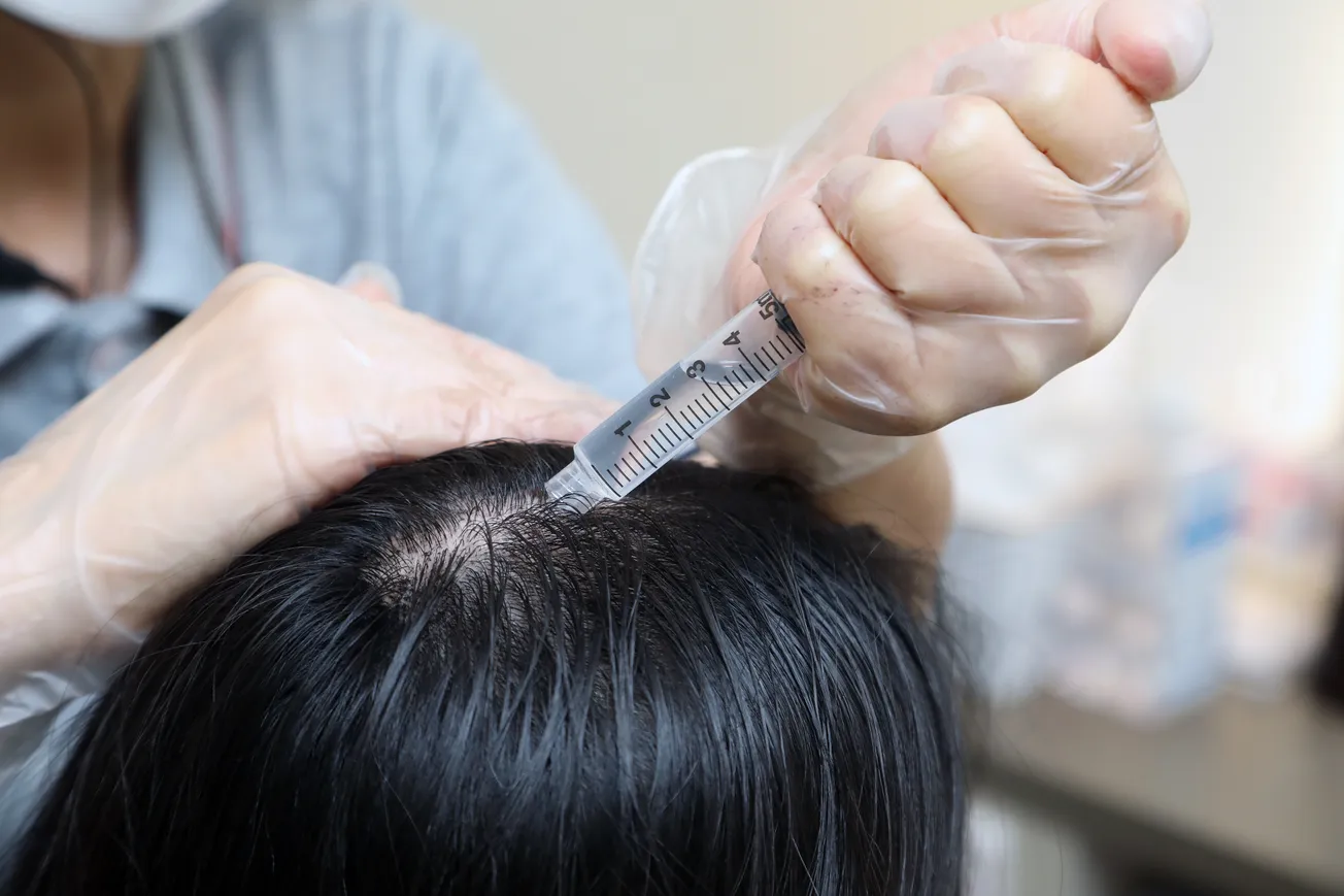 【用家實測】中醫可以醫頭油、改善脫髮？油頭中女實測德善健髮中醫藥療程好唔好！